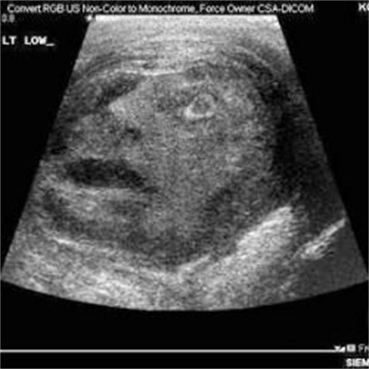 Freaky Ultrasound Photo: Mass In Testicle A Screaming Face