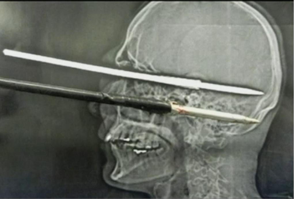 Warning! Graphic: Man Shot In Head With Harpoon Gun – And Lives!